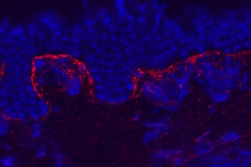 Immunofluoresenssikuvassa näkyy ihokeliakialle tyypillistä immunoglobuliini A-kertymää  (punainen väri) dermiksen yläosassa.  Solujen tumat näkyvät kuvassa sinisenä.